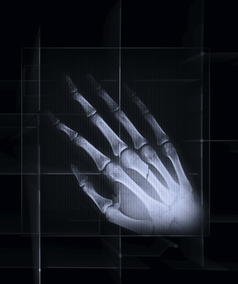 x-ray of a hand